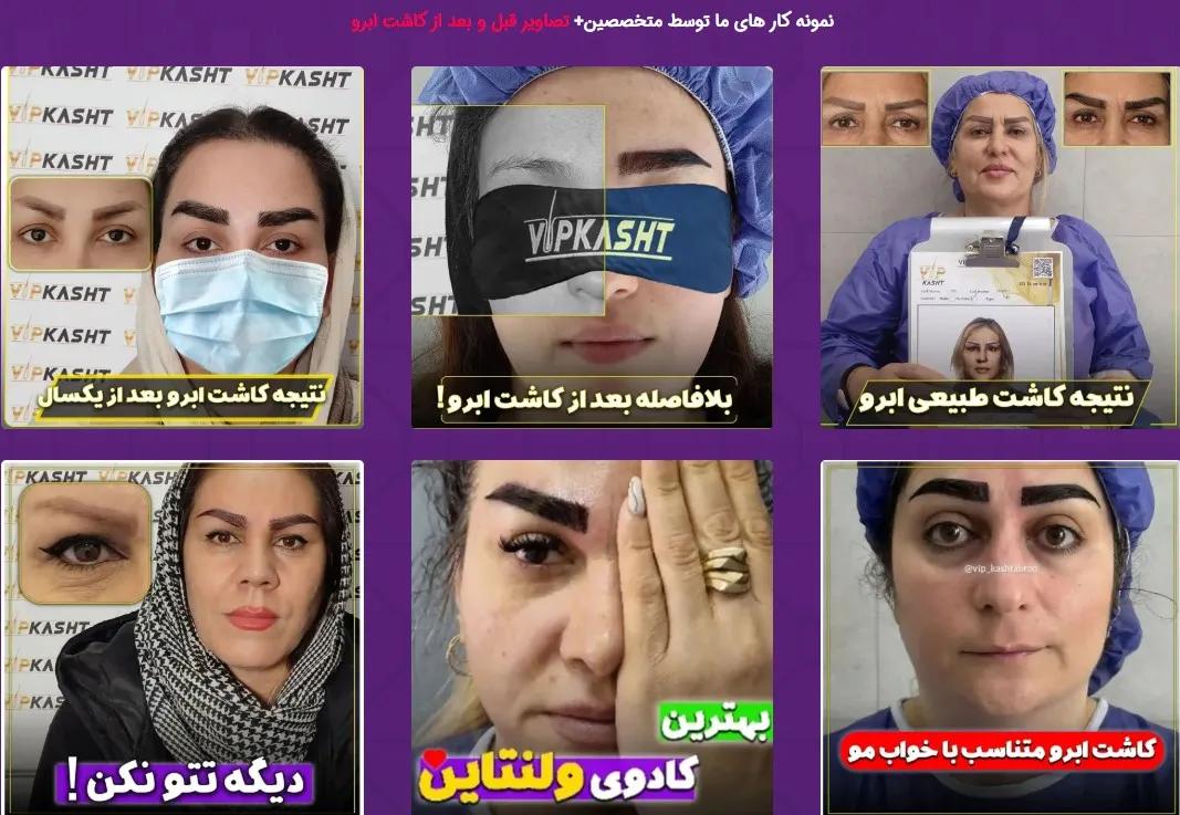 کلینیک VIP: ظرافت و دقت در کاشت ابرو